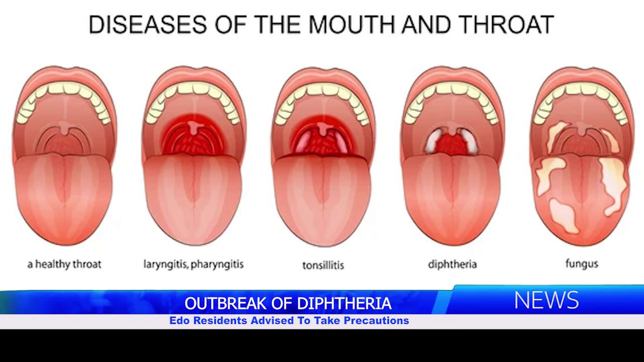 OUTBREAK OF DIPHTHERIA: Edo Residents Advised To Take Precautions